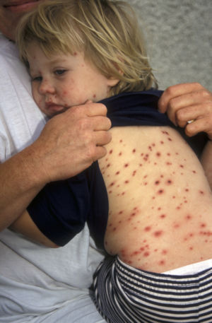 Child with chickenpox rash on her back held by her mother.